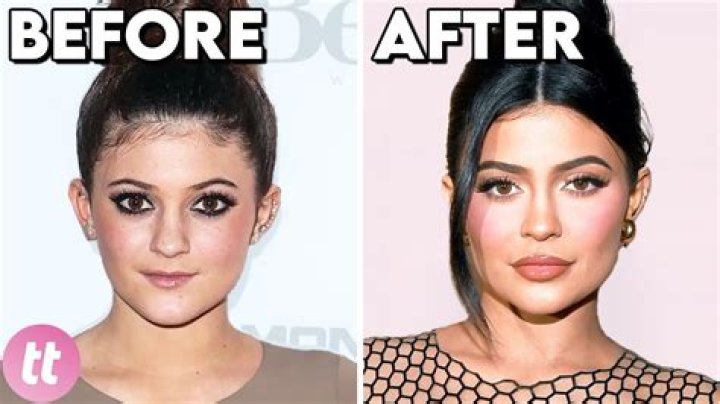 Celebrities Before & After Plastic Surgery — Photos